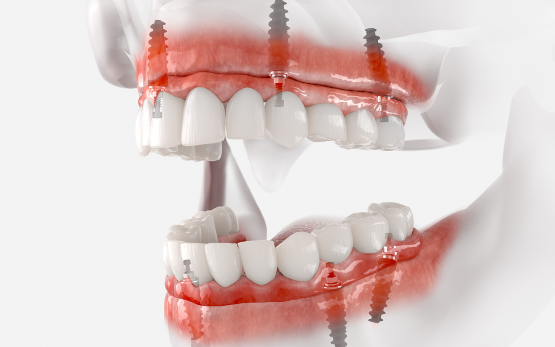 Are Implant-Supported Dentures Like Traditional Dentures?