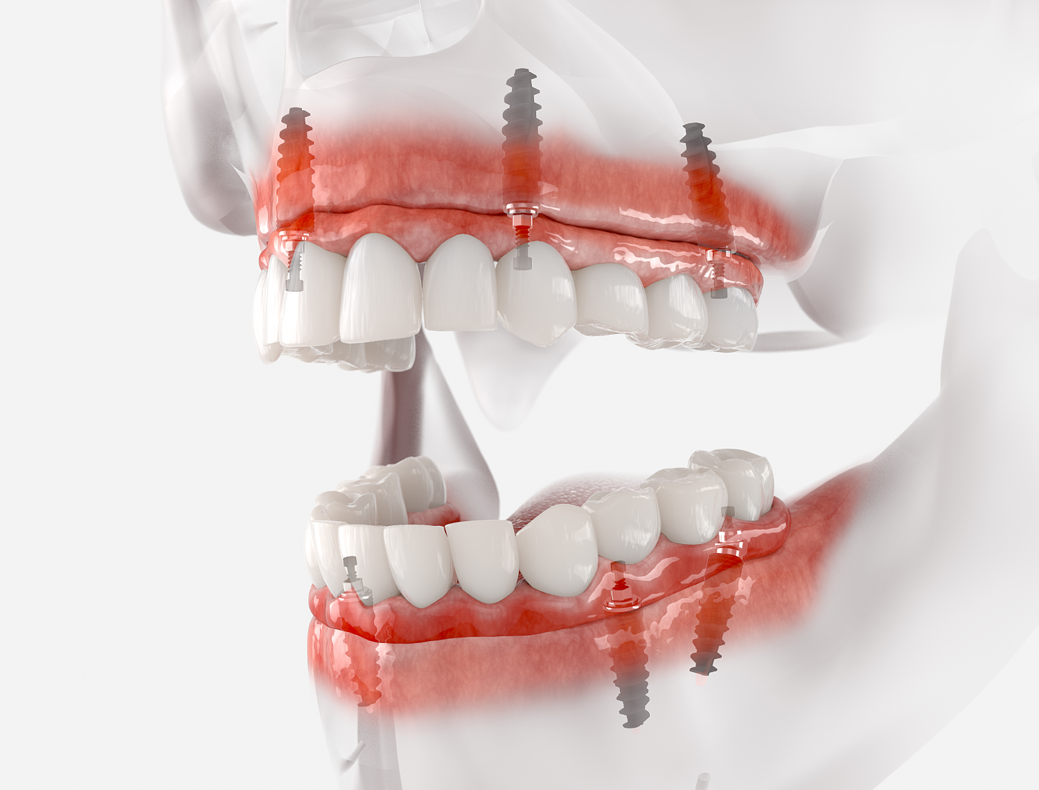 implant-supported-dentures