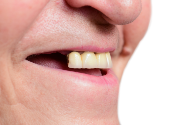 missing-teeth-problem