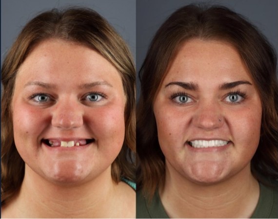 Mikayla before and after her smile treatment with Esteem Dental Implants